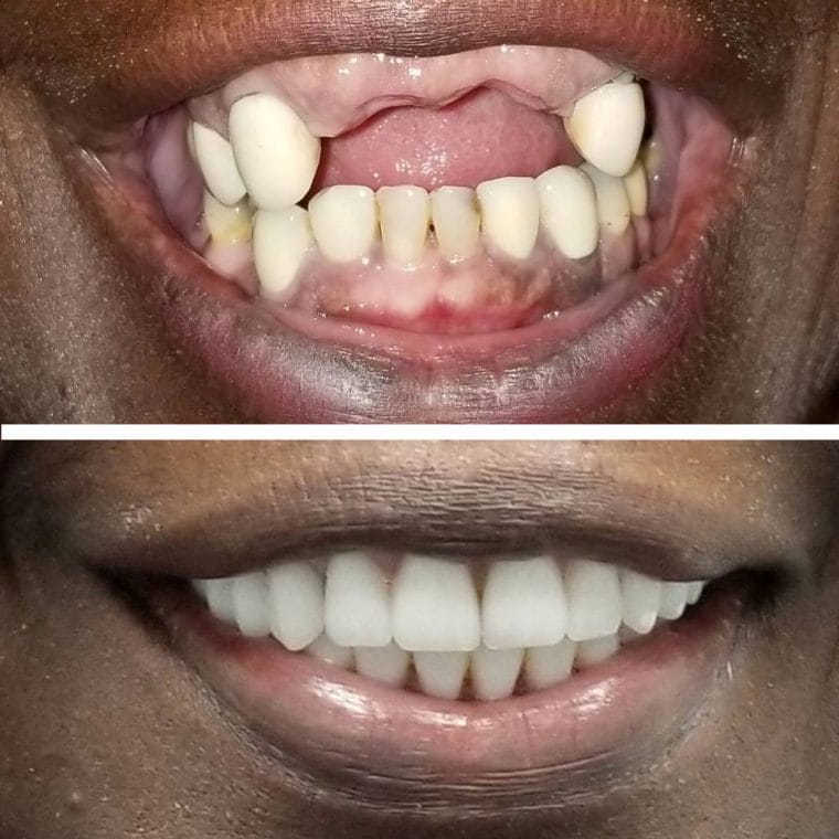 Dental bonding and contouring before and after result